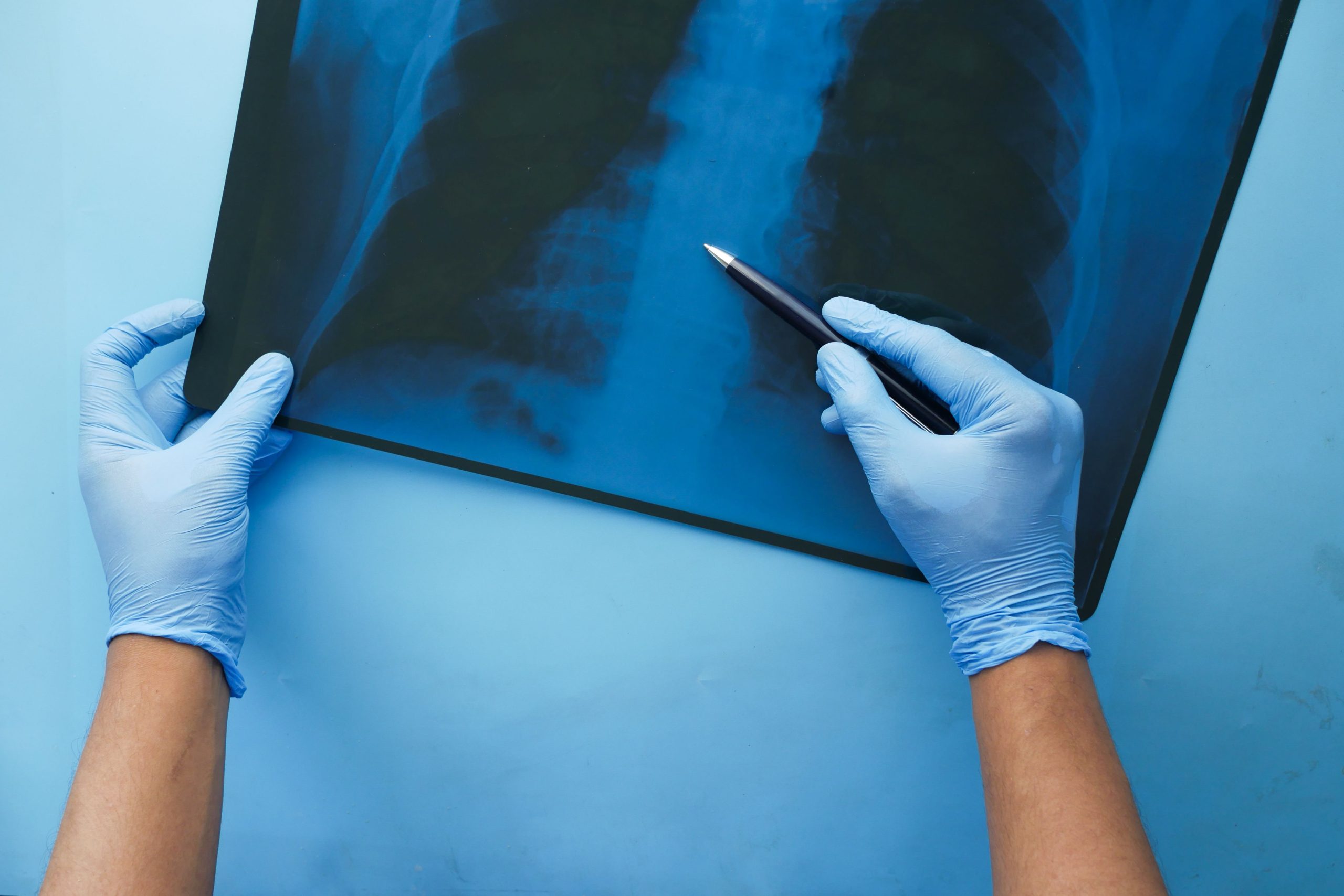 Symptômes et complications de la fibrose pulmonaire