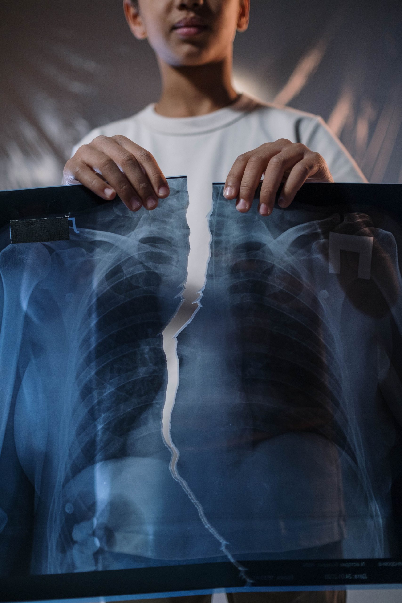 Progression de la fibrose pulmonaire dans les poumons