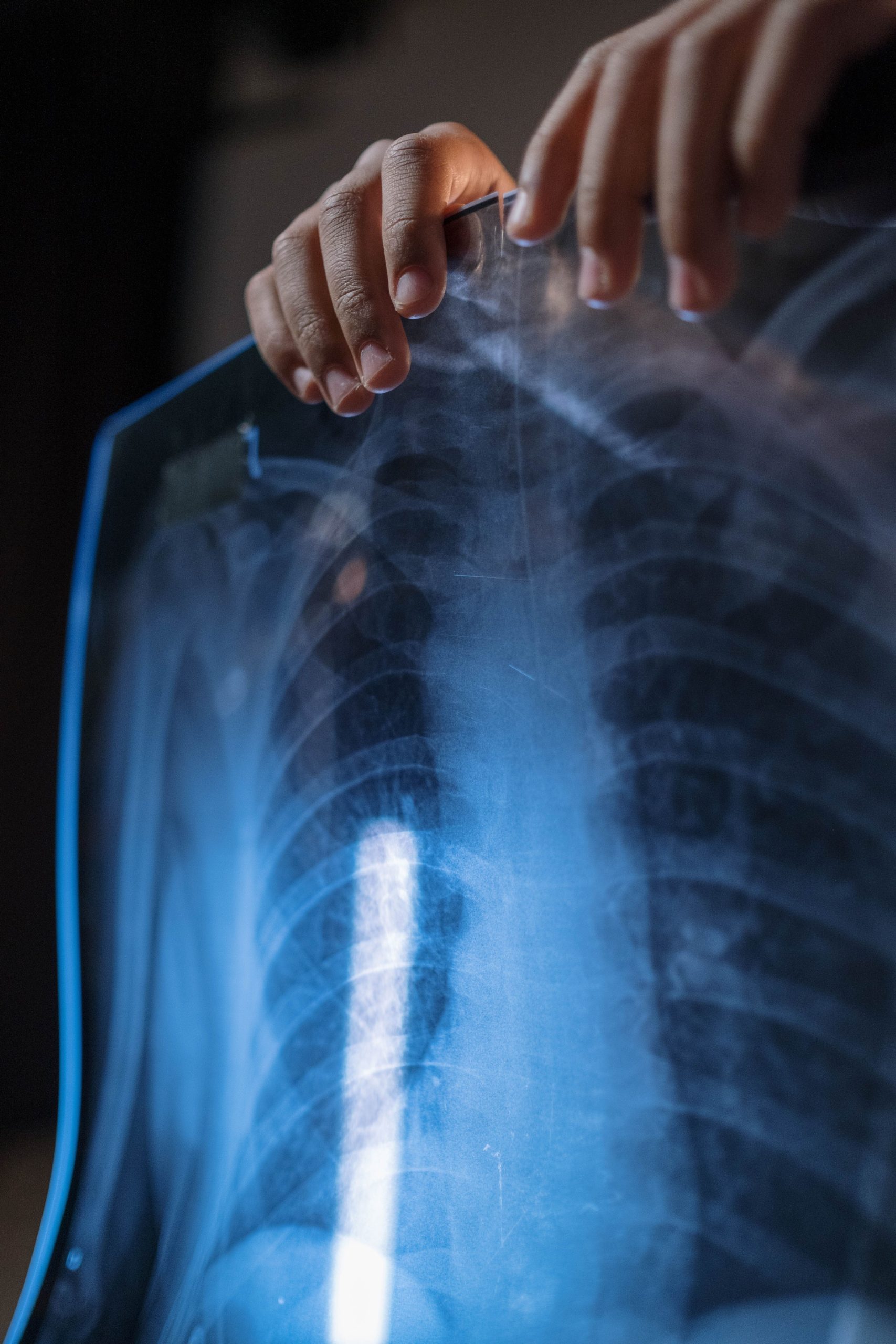 Diagnostic et mécanismes de décès en fibrose pulmonaire